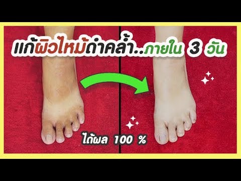 วิธีจัดการผิวไหม้ดำคล้ำ แห้งกร้าน ให้ขาวรวดเร็วได้ผล 100% (สูตรคัดมาแล้ว) Remove Sun tan skin fast