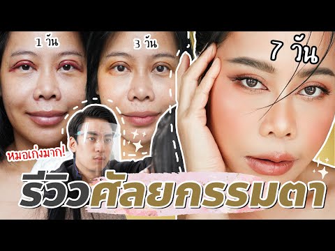 รีวิวศัลยกรรมตาสองชั้น เก็บหนังตาตก แทบไม่ต้องพักฟื้น 3 วันทำงานได้เลย | BEAUTY MOUTHSY